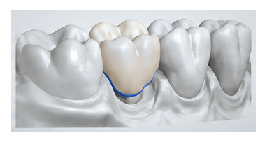 Digital crown restoration design form